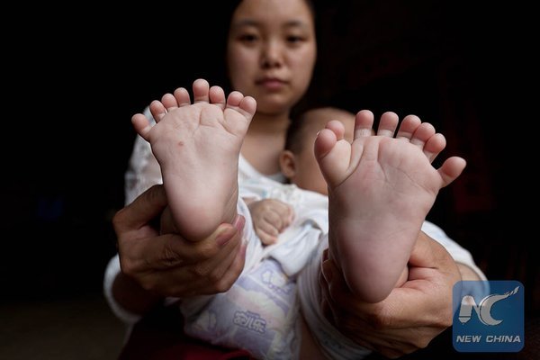 Chinese baby afwijkingen