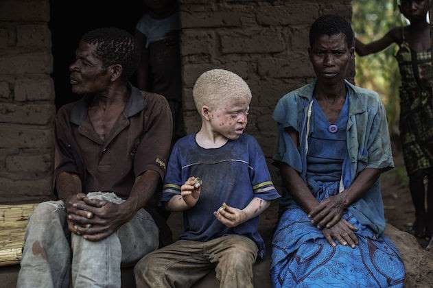 Malawi albino
