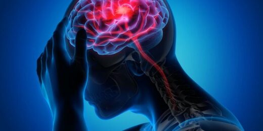 grafische weergave hersenen hoofdpijn beroerte